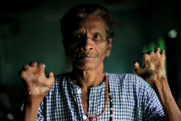 Rumania Catat Kasus Kusta